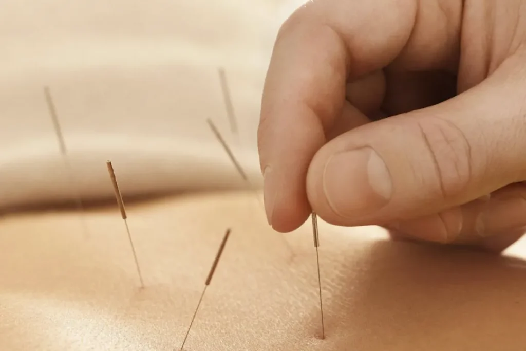Acupuntura